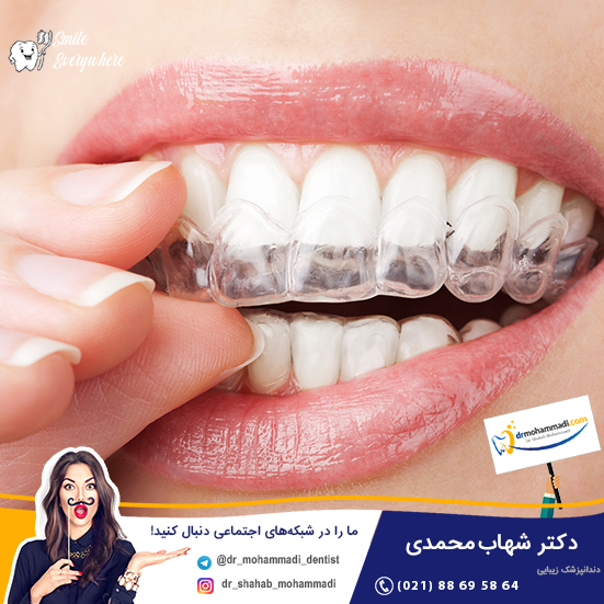 ارتودنسی نامرئی و هر آنچه باید در مورد آن بدانید